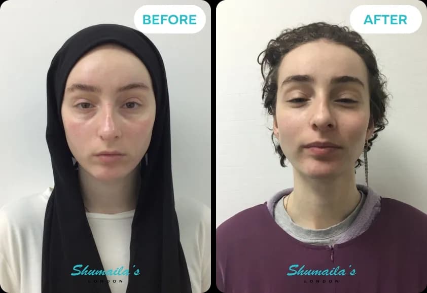 HydraFacial