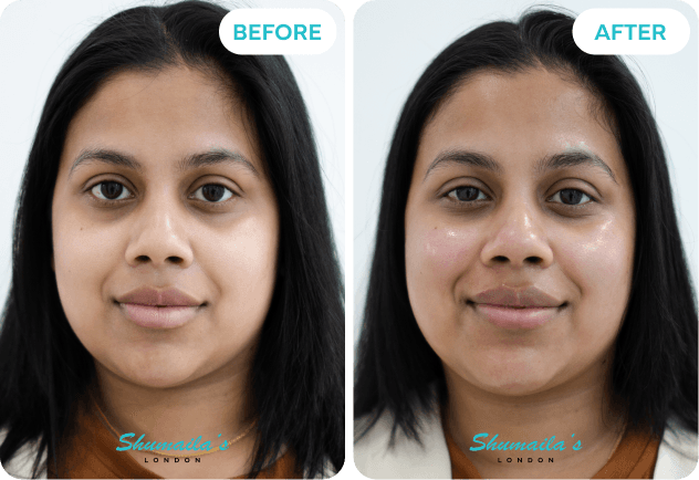 HydraFacial