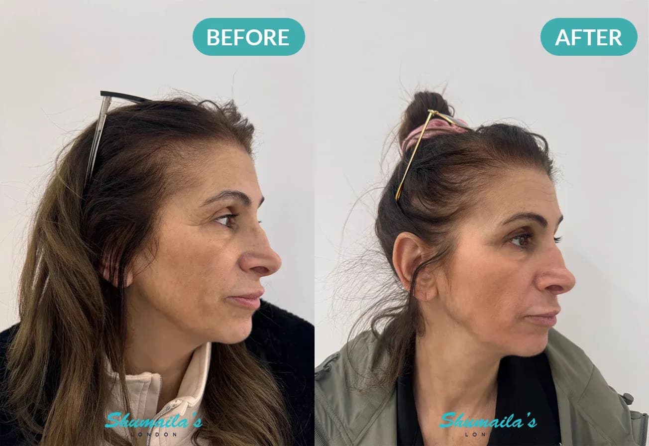 After HydraFacial treatment – smoother skin, brighter tone, and improved facial contour
