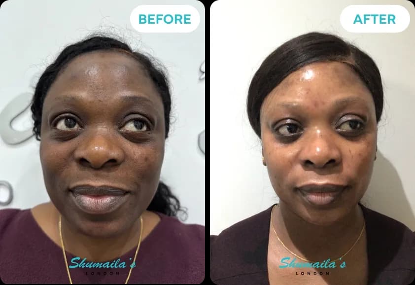 Hyperpigmentation Treatment