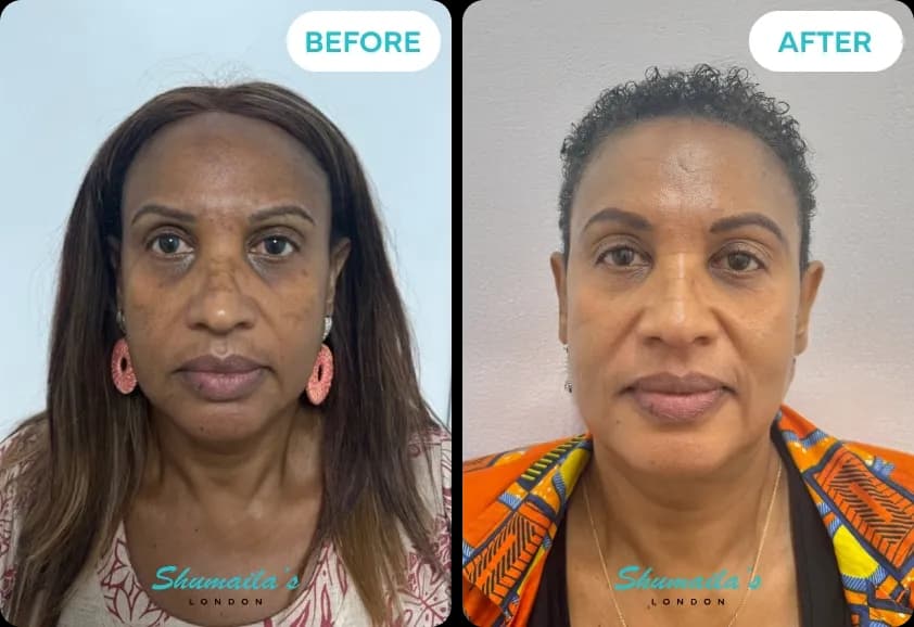 Hyperpigmentation Treatment