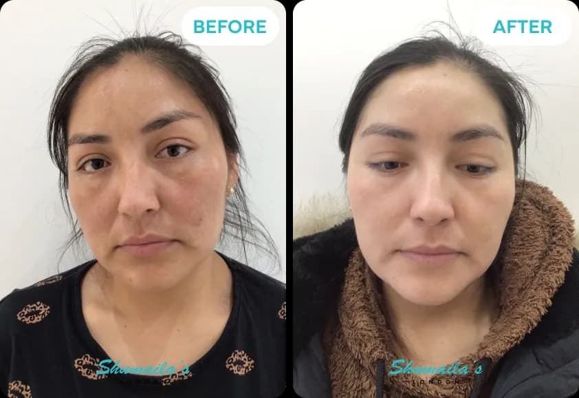 Hyperpigmentation Treatment