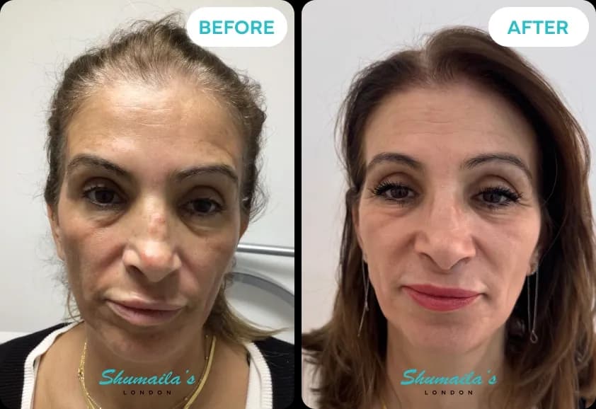 Hyperpigmentation Treatment