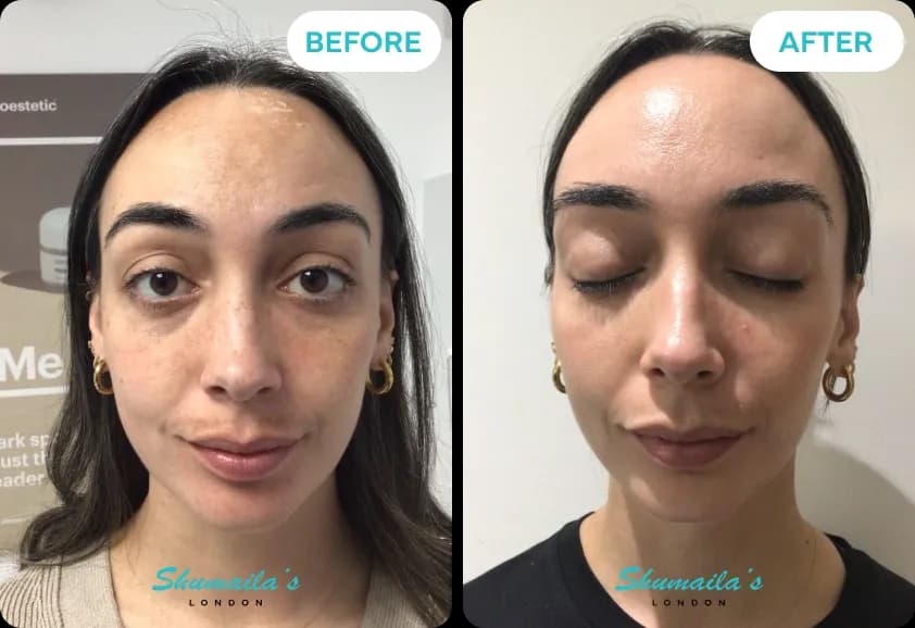 Hyperpigmentation Treatment