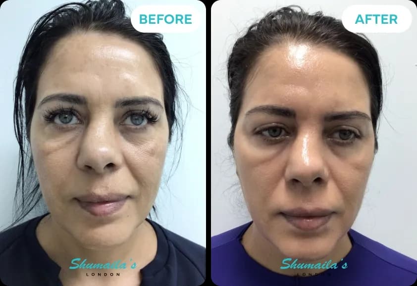 Hyperpigmentation Treatment
