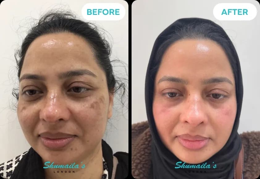 Hyperpigmentation Treatment
