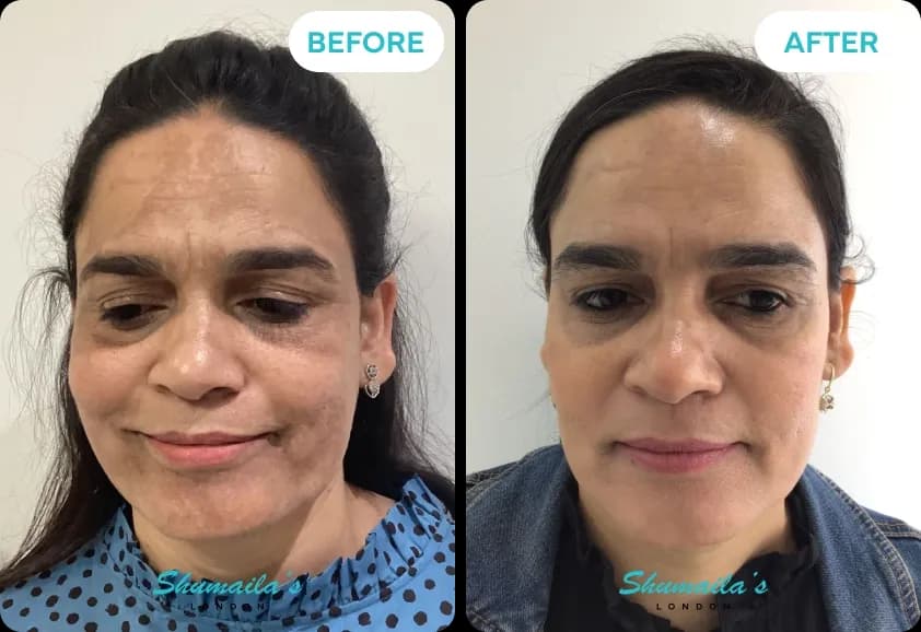 Hyperpigmentation Treatment