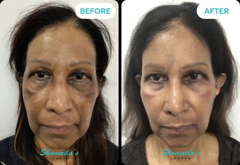Hyperpigmentation Treatment
