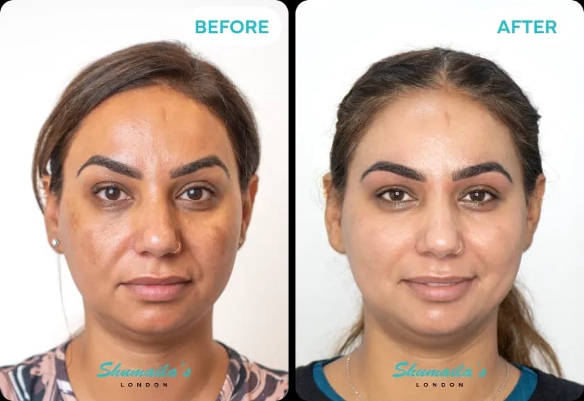 Hyperpigmentation Treatment