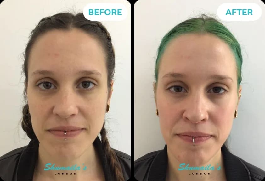 Hyperpigmentation Treatment