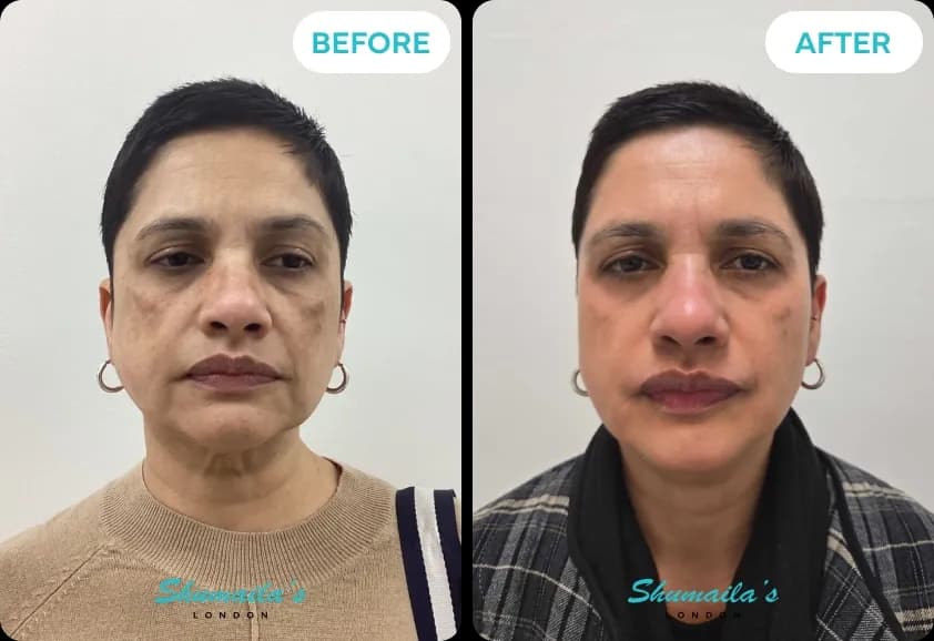 Hyperpigmentation Treatment