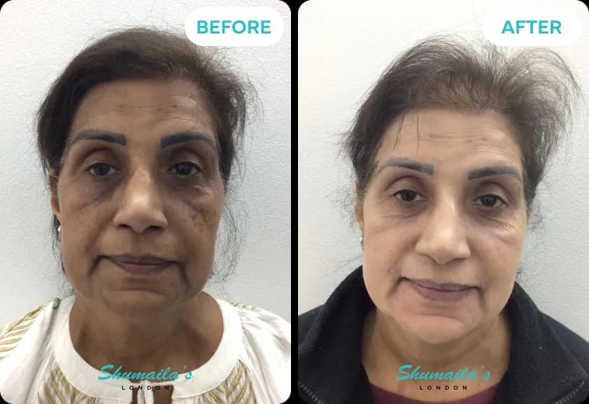 Hyperpigmentation Treatment