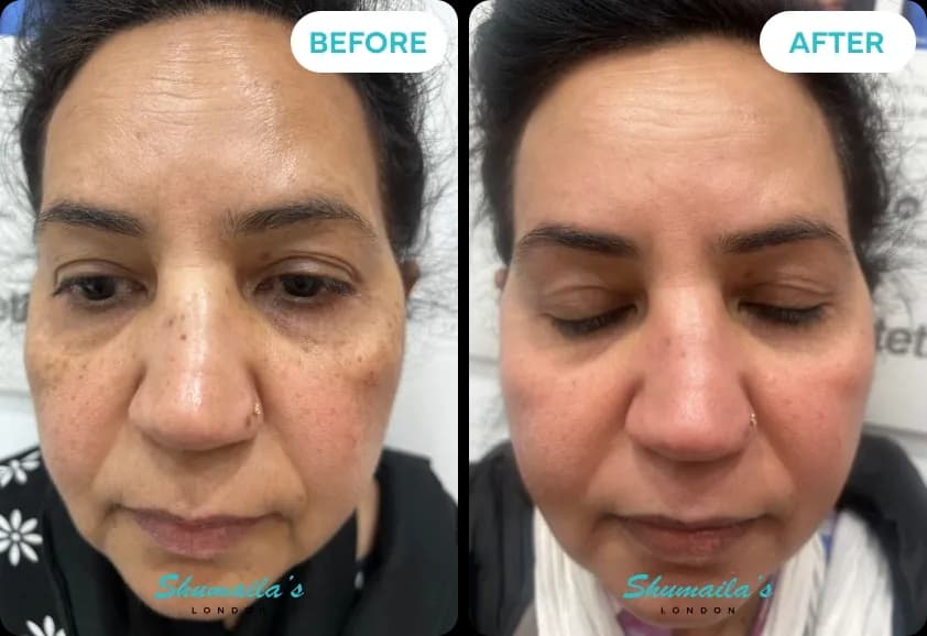 Hyperpigmentation Treatment