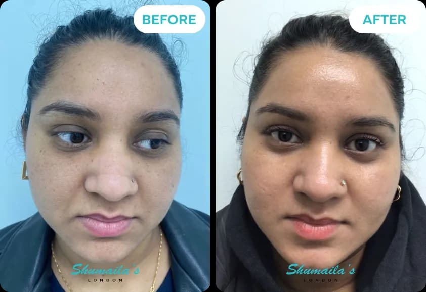 Hyperpigmentation Treatment