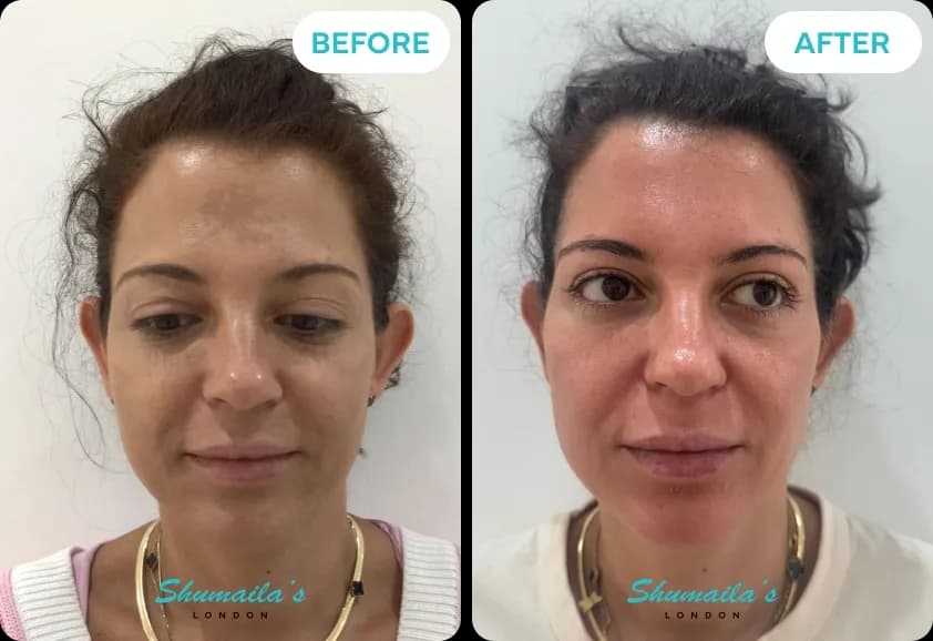 Hyperpigmentation Treatment