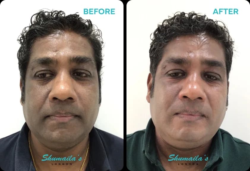 Hyperpigmentation Treatment