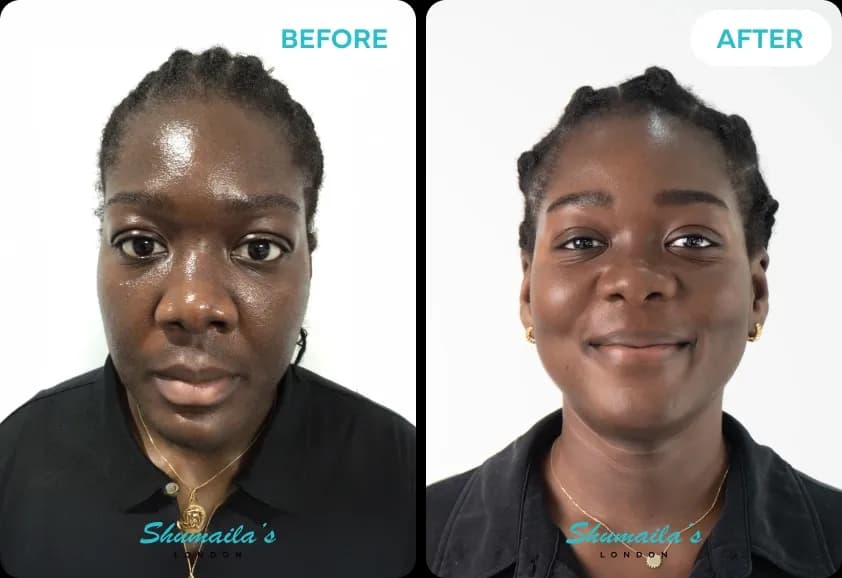 Hyperpigmentation Treatment