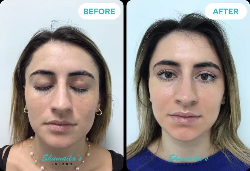 Hyperpigmentation Treatment