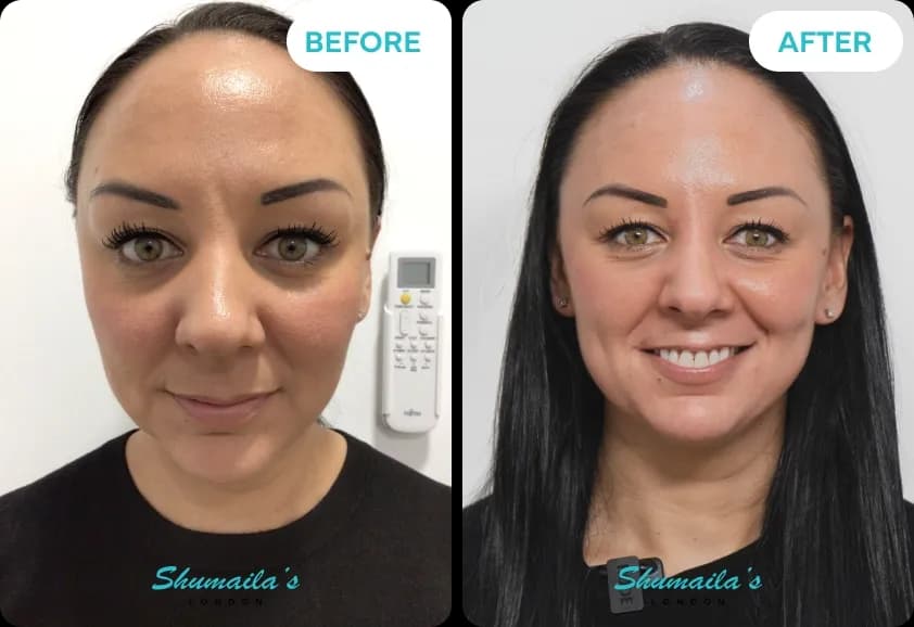 Hyperpigmentation Treatment