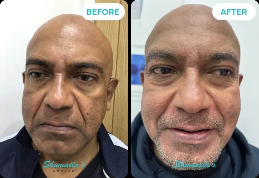 Hyperpigmentation Treatment