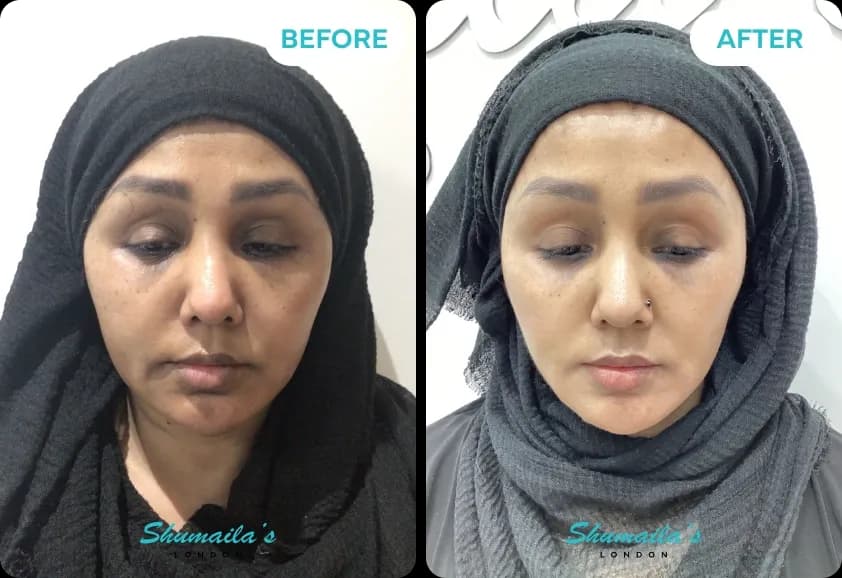 Hyperpigmentation Treatment