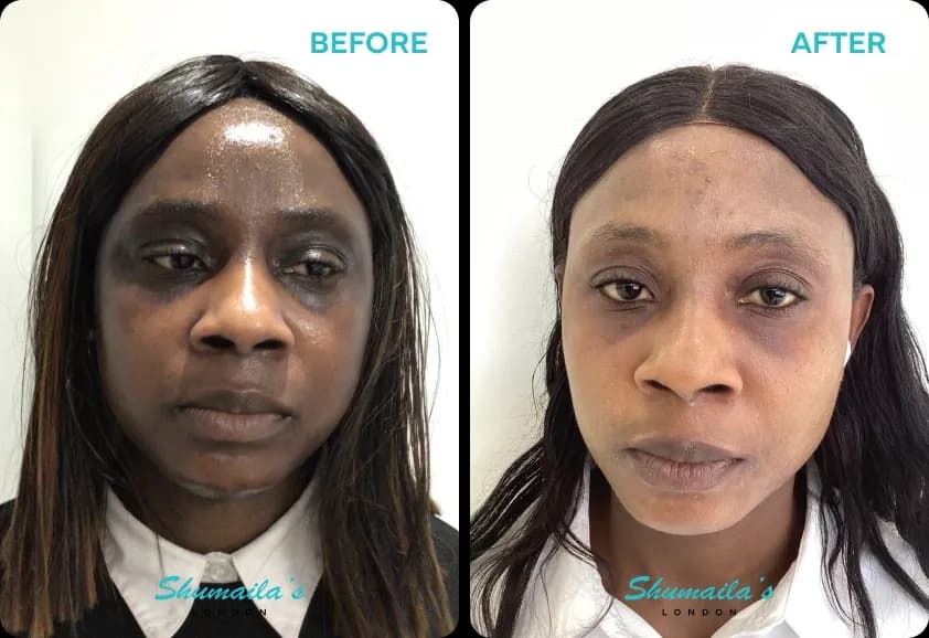 Hyperpigmentation Treatment