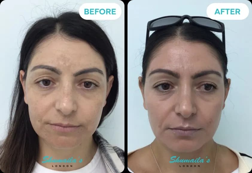 Hyperpigmentation Treatment
