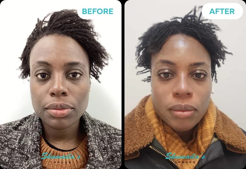 Hyperpigmentation Treatment
