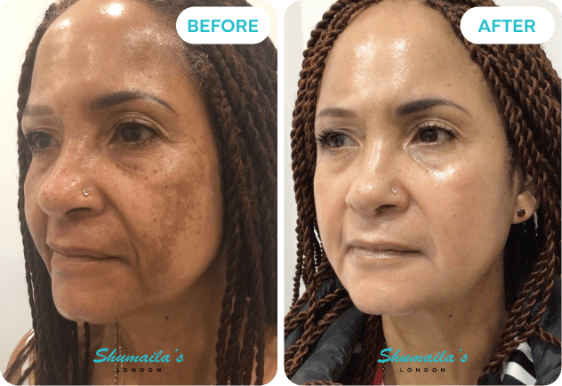 Hyperpigmentation Treatment