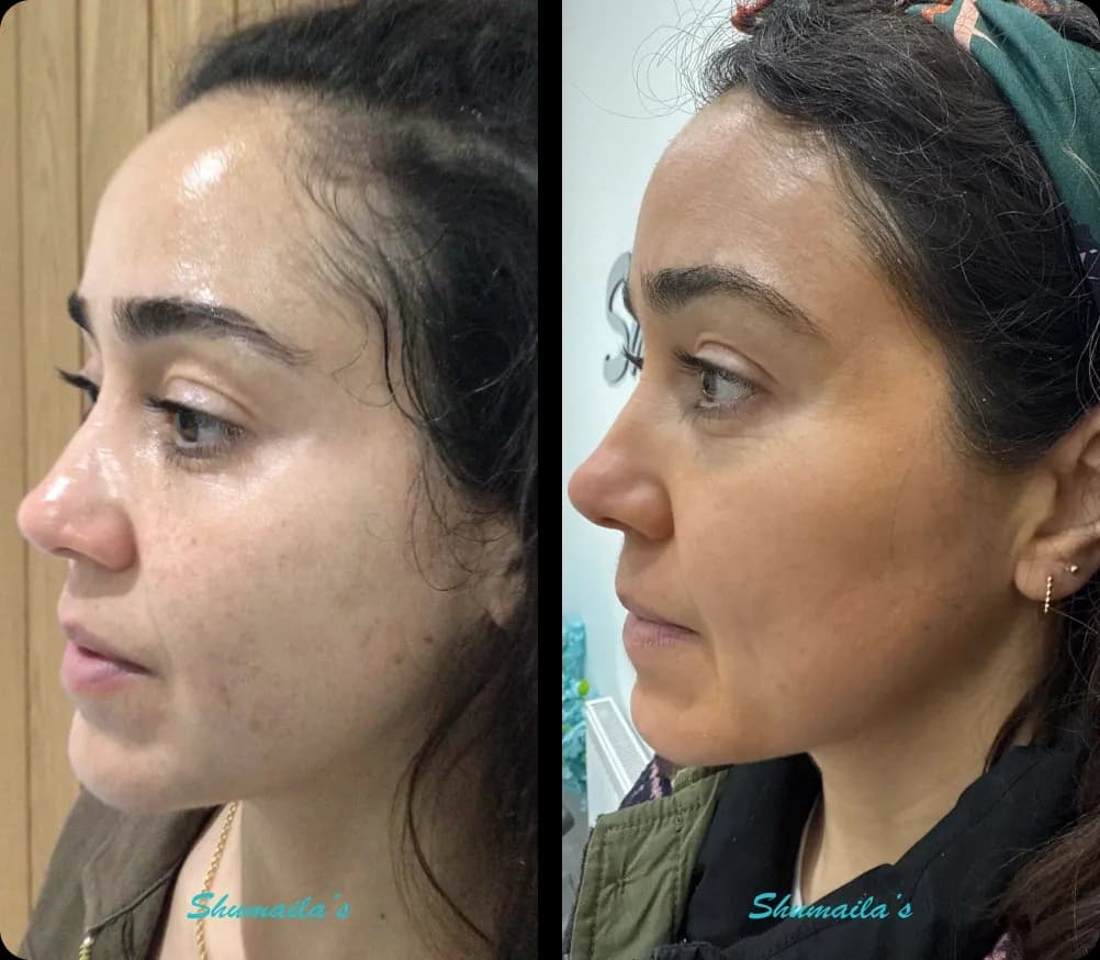 Melasma Treatment