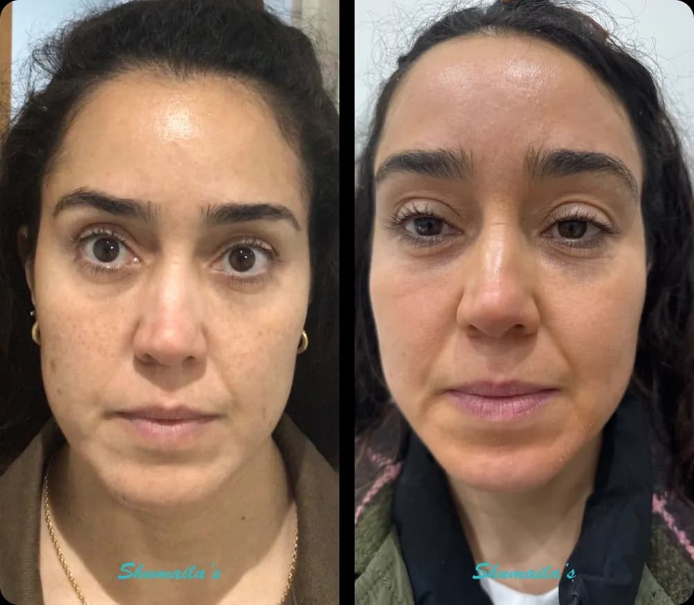 Melasma Treatment