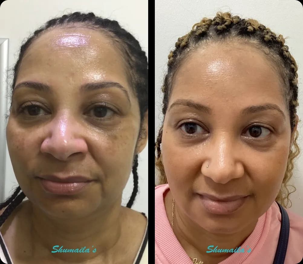 Melasma Treatment