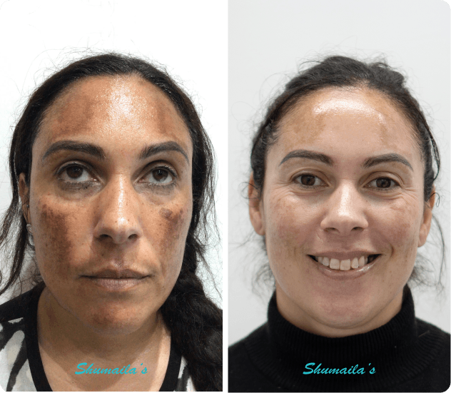 Melasma Treatment