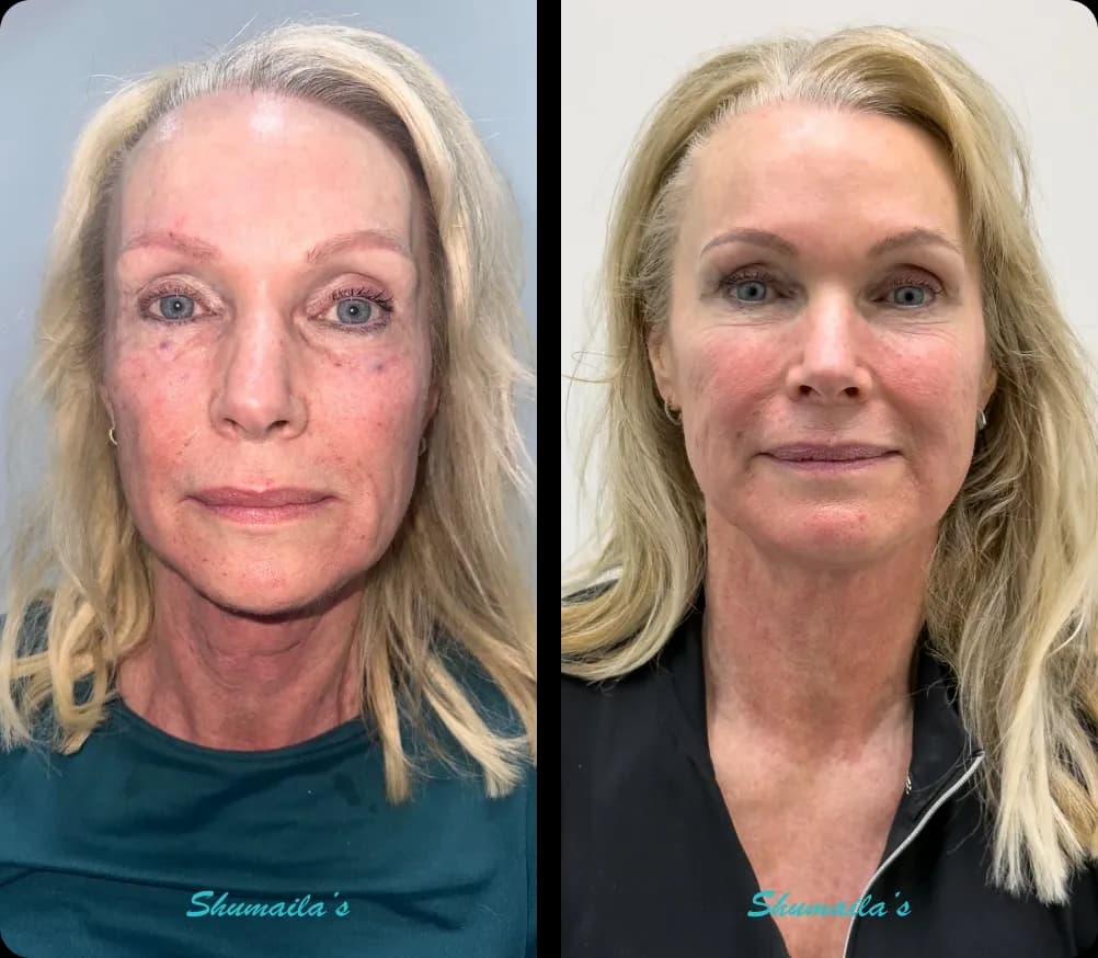 Morpheus8 RF Microneedling