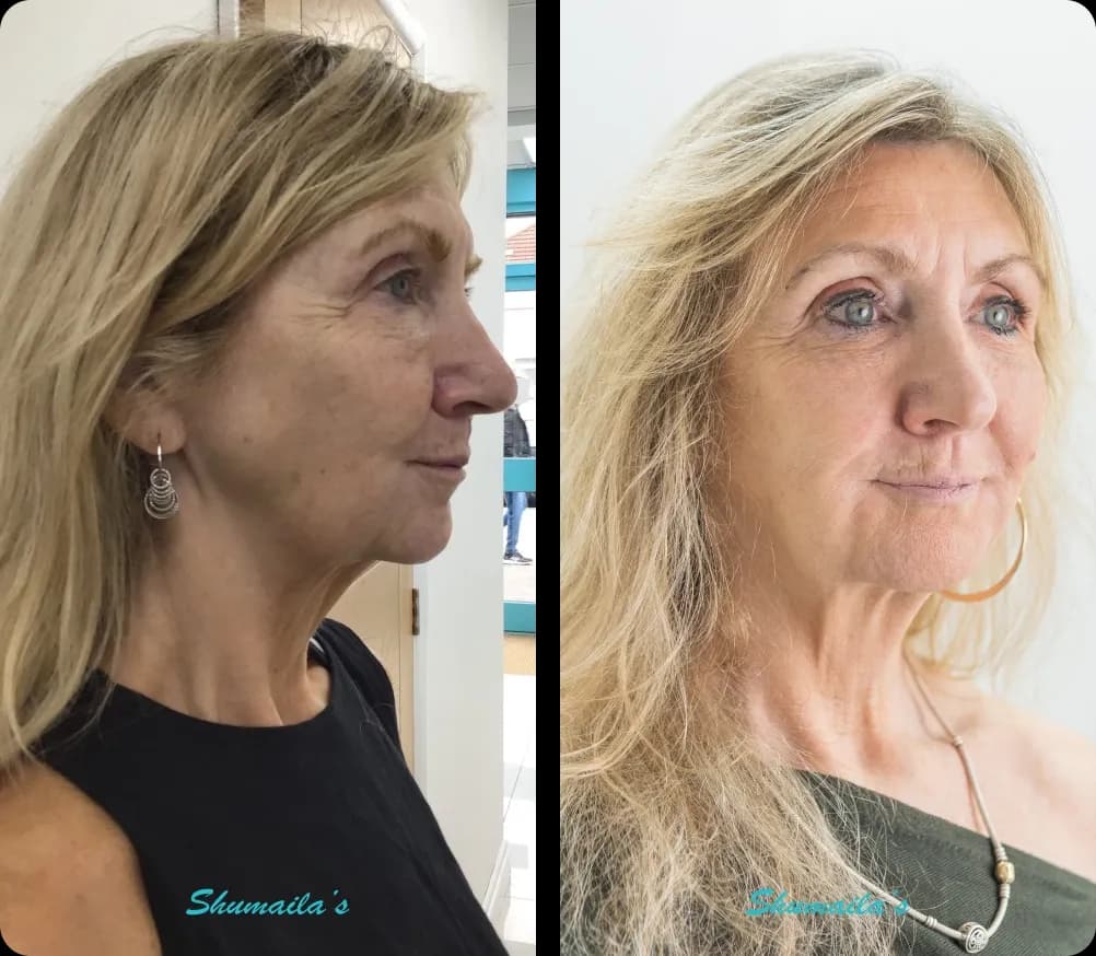 Morpheus8 RF Microneedling