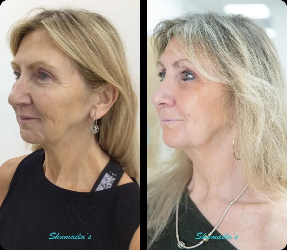 Morpheus8 RF Microneedling