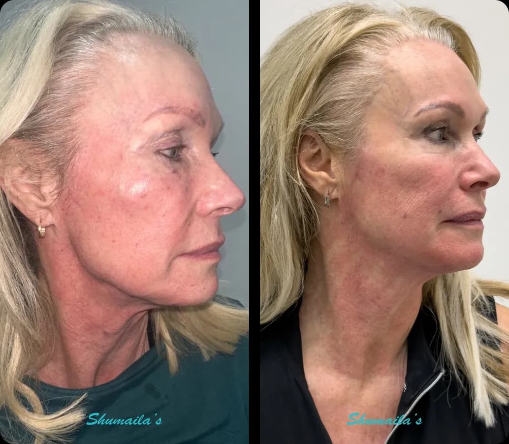 Morpheus8 RF Microneedling