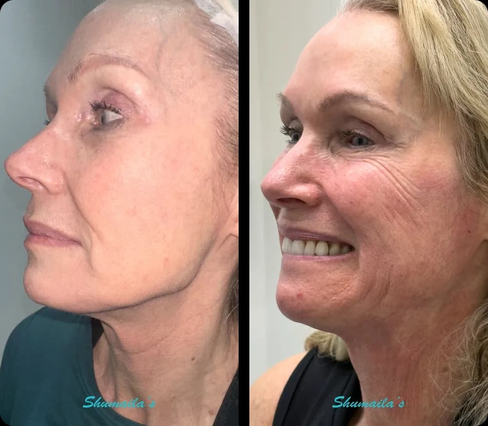 Morpheus8 RF Microneedling