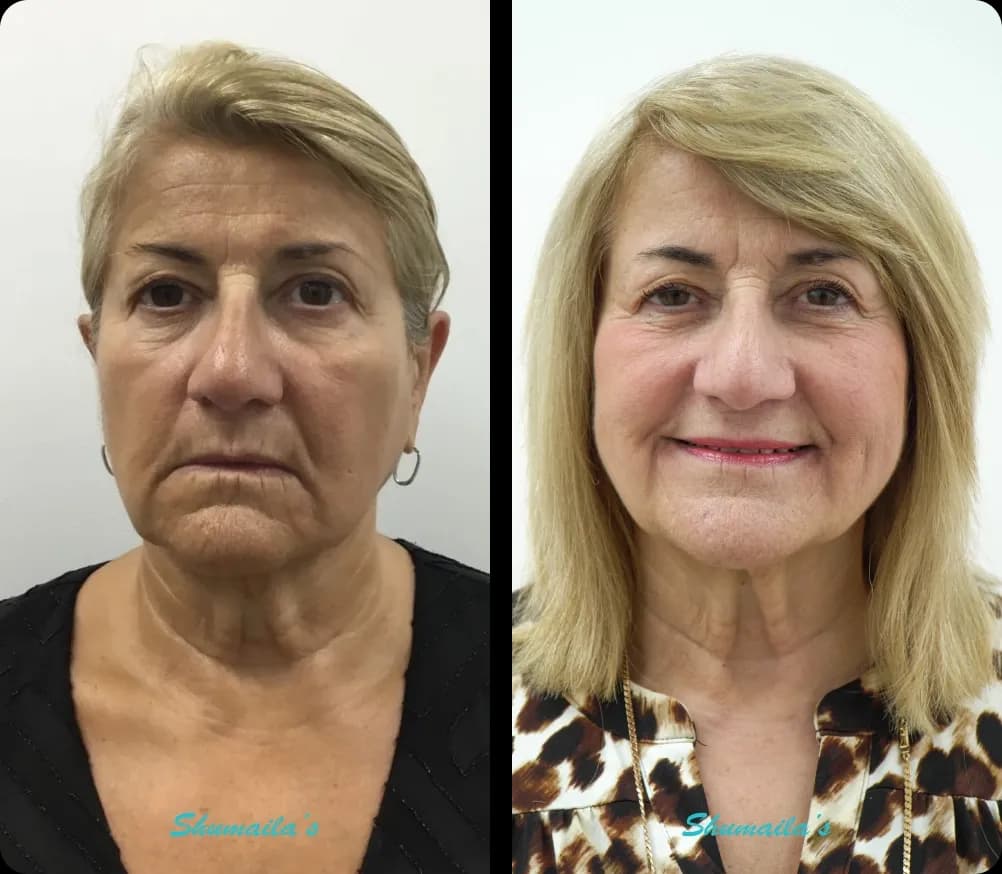 Morpheus8 RF Microneedling