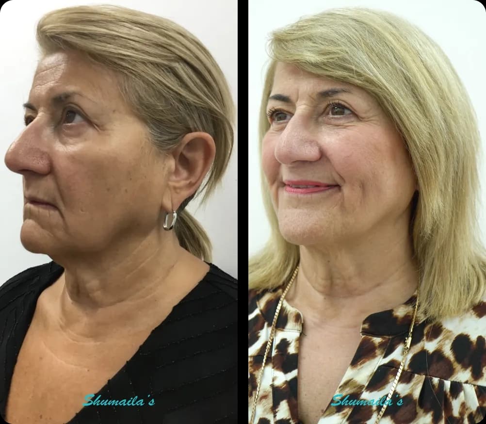 Morpheus8 RF Microneedling