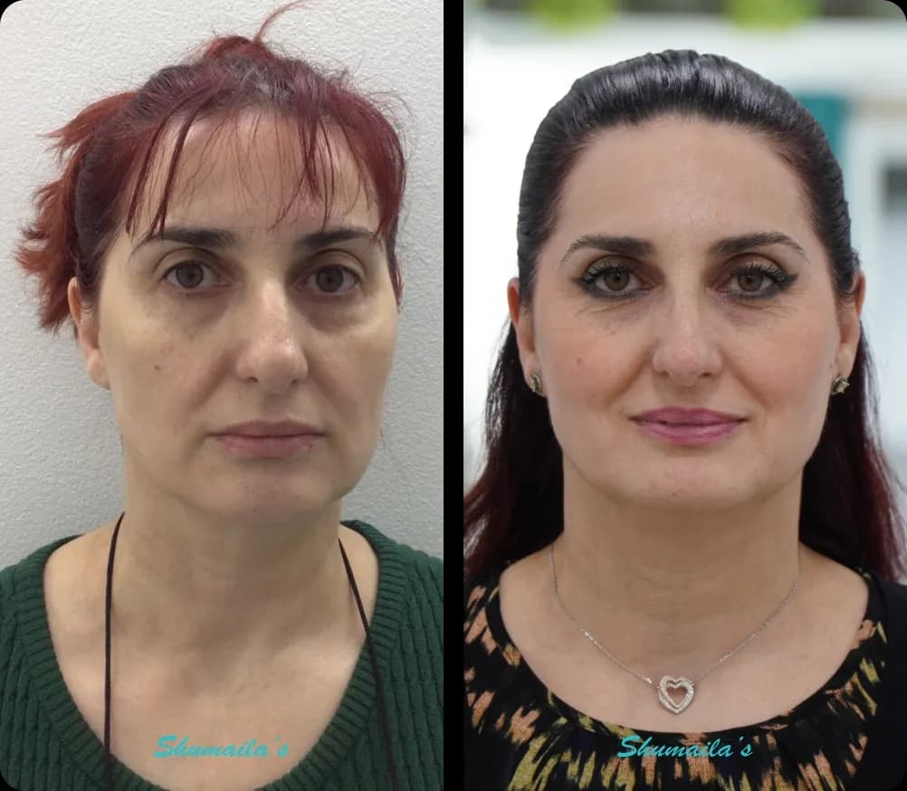 Morpheus8 RF Microneedling