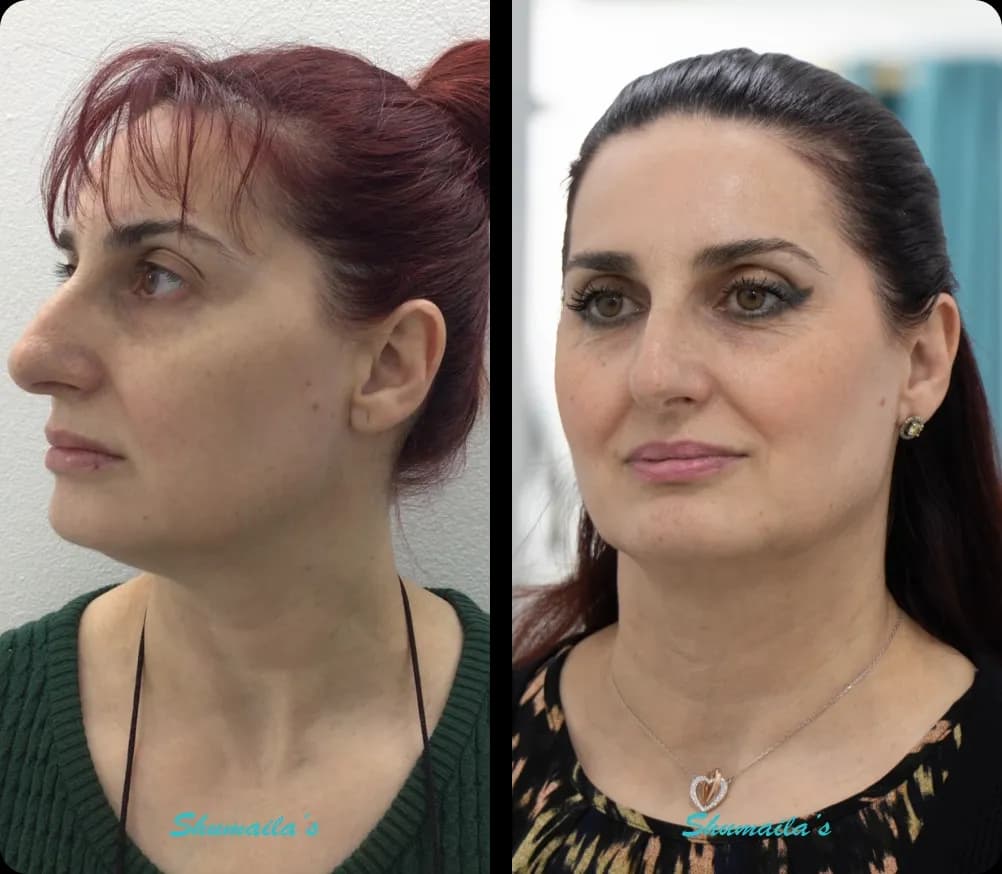 Morpheus8 RF Microneedling