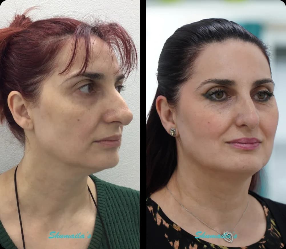 Morpheus8 RF Microneedling