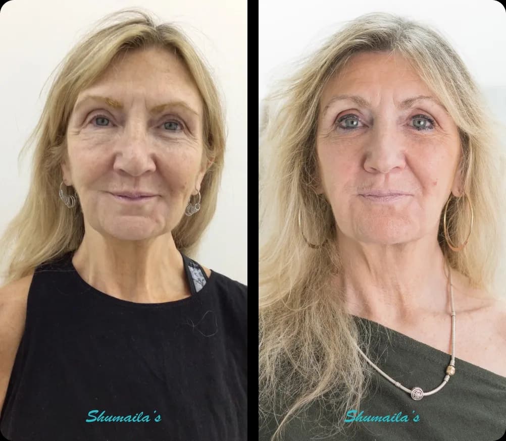 Morpheus8 RF Microneedling