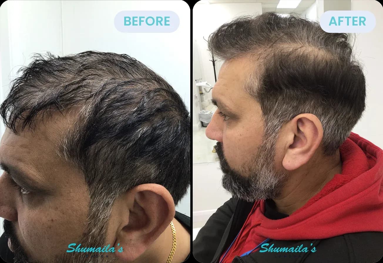 Male Hair Loss Treatment
