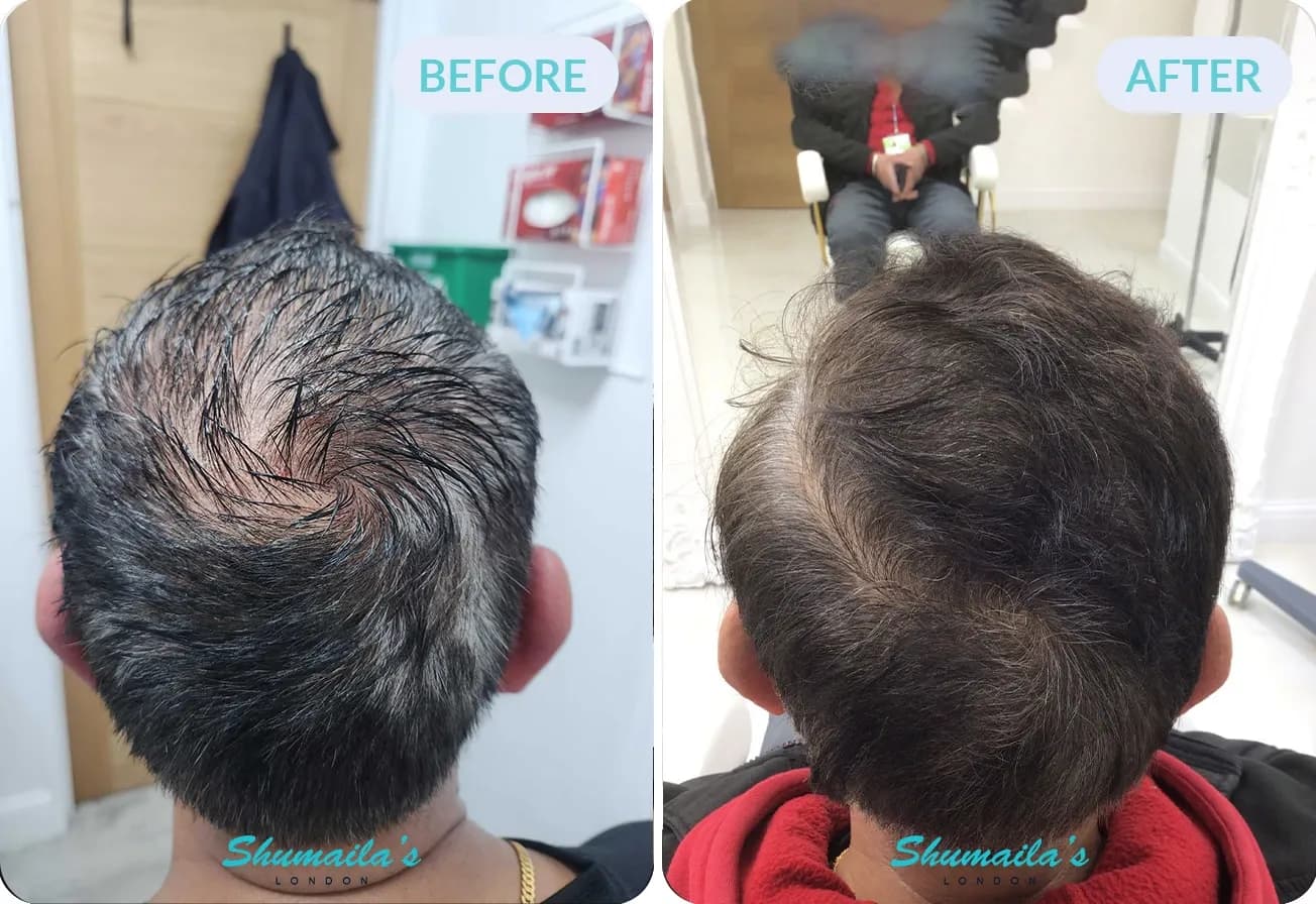 Male Hair Loss Treatment
