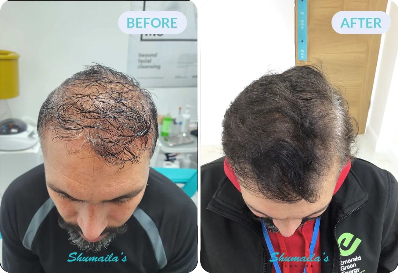 Male Hair Loss Treatment