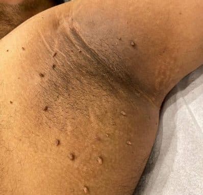skin tags removal london