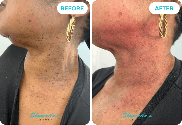 Skin Tag Removal