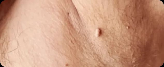 skin type1